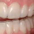 Can a Dentist Whiten Teeth?