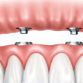 Finding the Right Dentist for Your Dentures